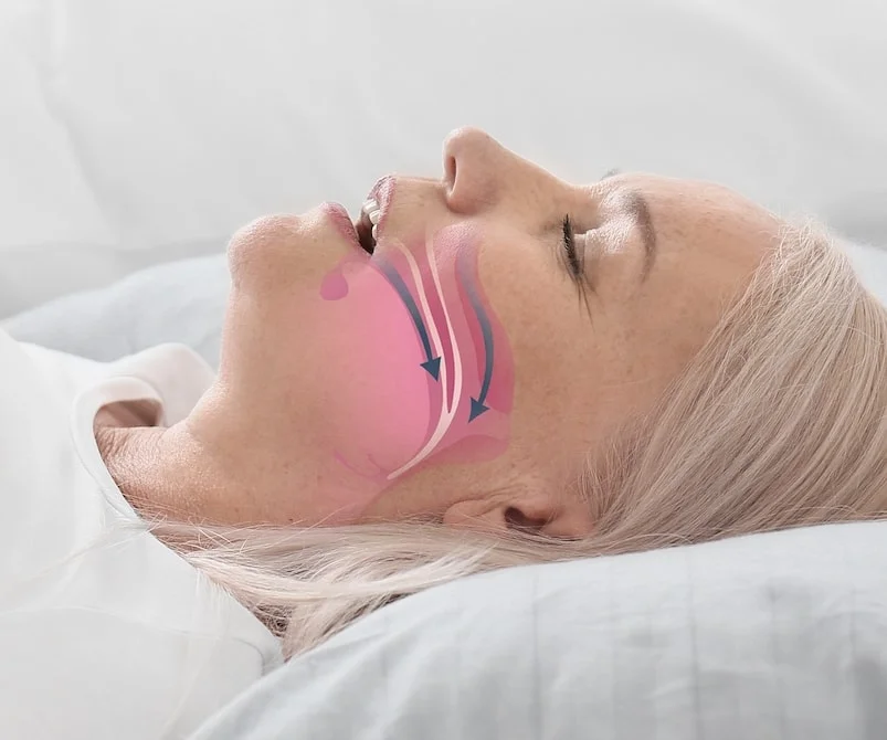 Obstructive Sleep Apnea Causes Symptoms Treatment