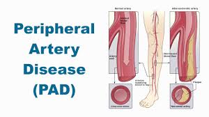 Peripheral Vascular Disease