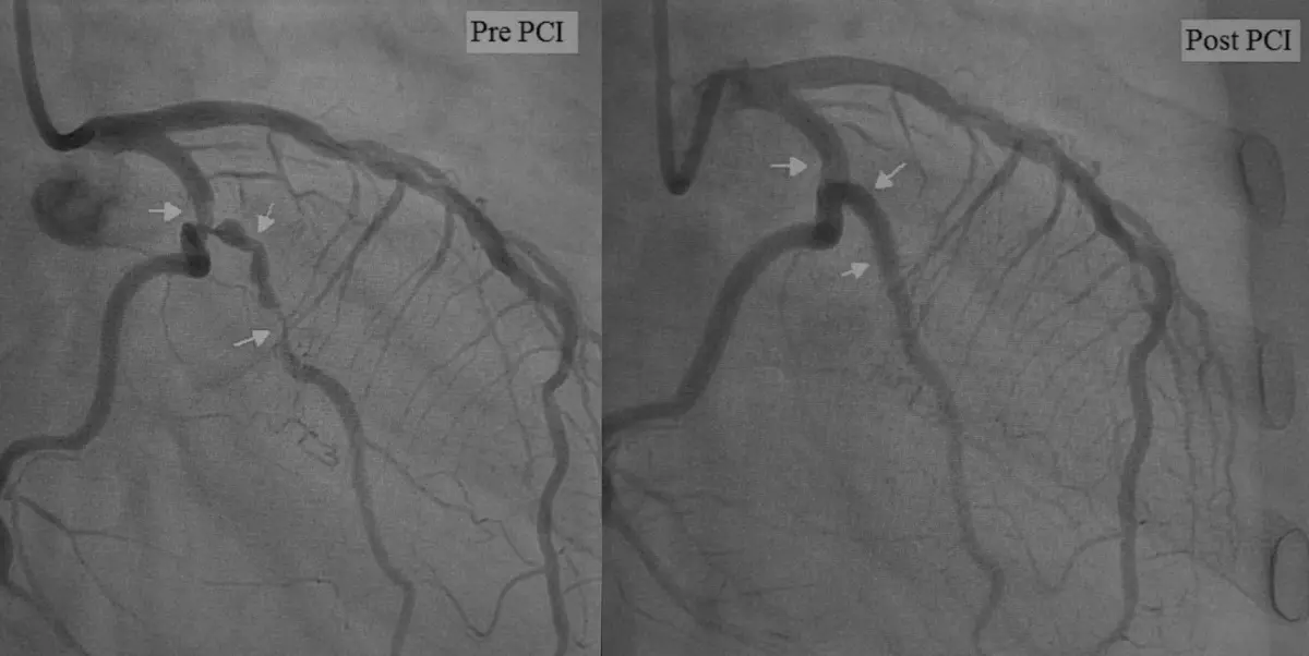 Coronary Angiography: Detailed Guide to Diagnosis